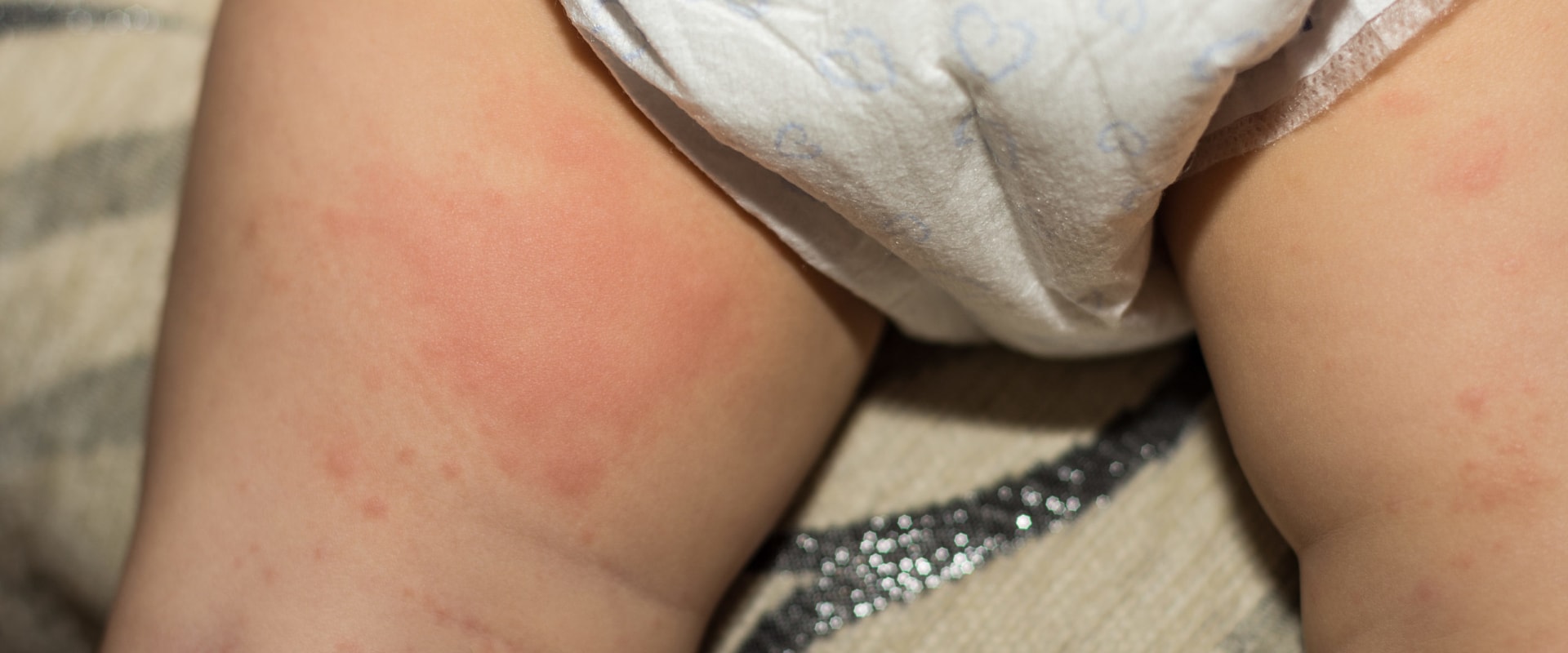 Understanding Contact with Urine and Stool and its Role in Diaper Rash Prevention