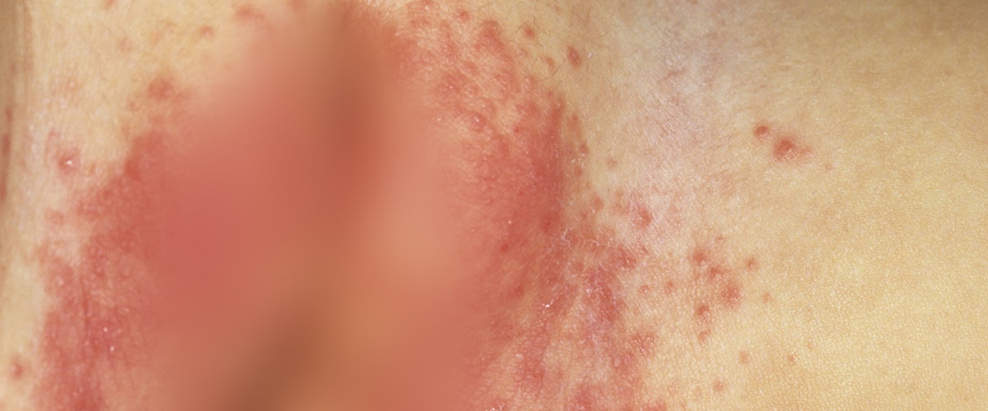 What does a diaper sensitivity rash look like?