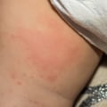 Understanding Contact with Urine and Stool and its Role in Diaper Rash Prevention