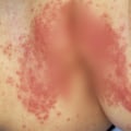 What does a diaper sensitivity rash look like?