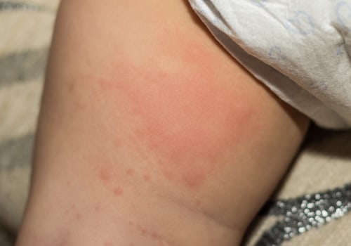 Understanding Contact with Urine and Stool and its Role in Diaper Rash Prevention