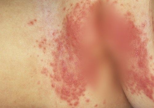 What does a diaper sensitivity rash look like?